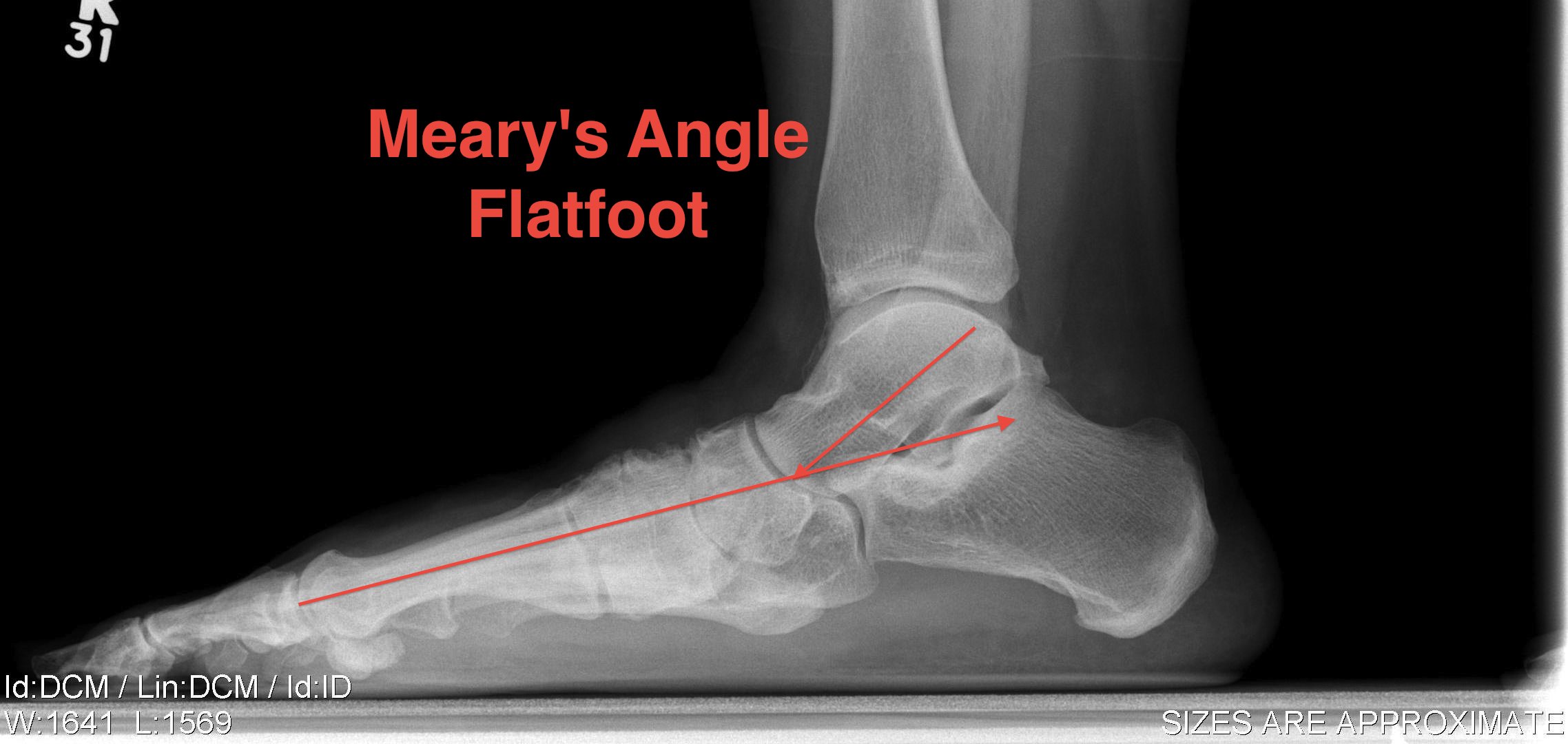 Planovalgus Foot Meary's Angle
